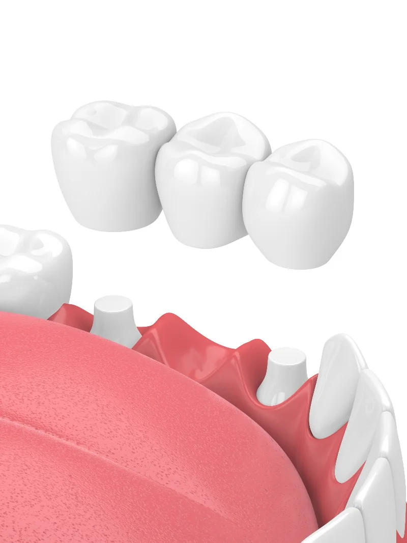 Dental crown and bridge restoration used by Bloom Dental in Bedford, IN