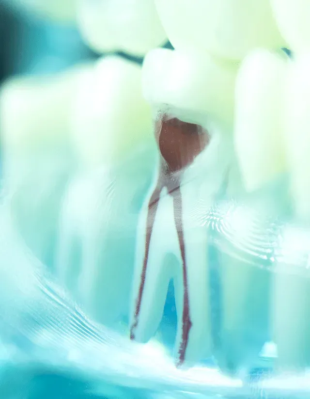 Diagram of the tooth pulp treated during root canal treatment in Plainfield, IN