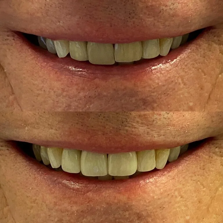 Before and After Dental Crowns