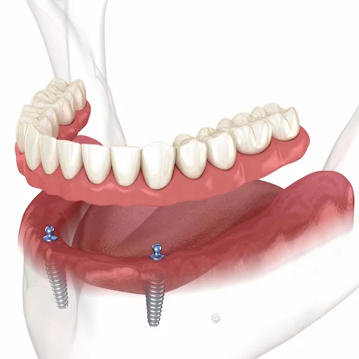 2 Implant Overdenture​ imge