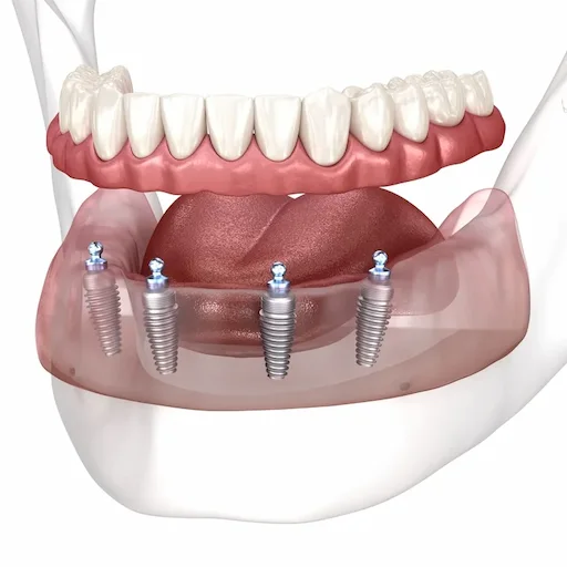 Implant-supported overdenture case at Bloom Dental Greenwood Indiana