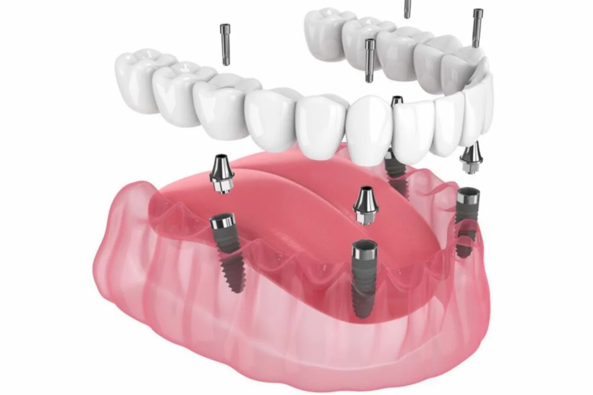 Full arch dental implant bridge result at Bloom Dental Greenwood Indiana