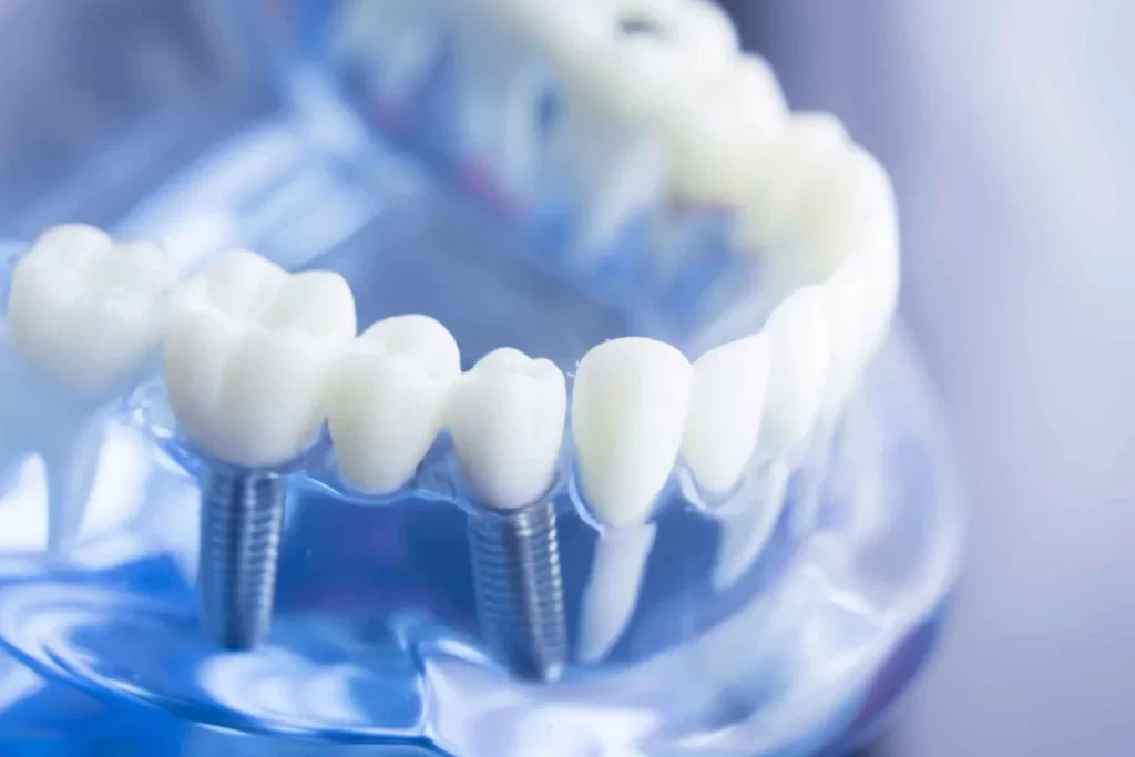 Full Mouth Dental Implants banner 2