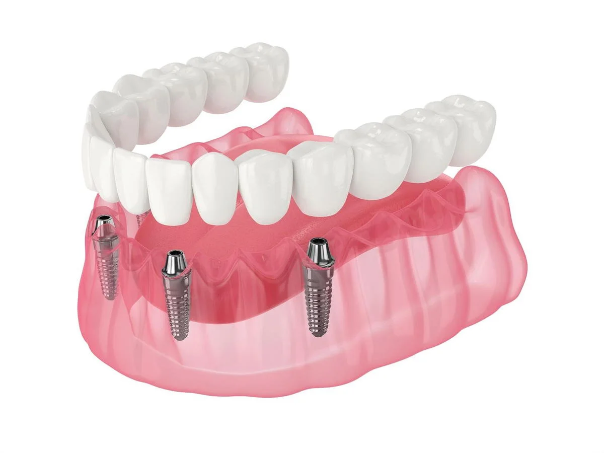 Full Mouth Implants