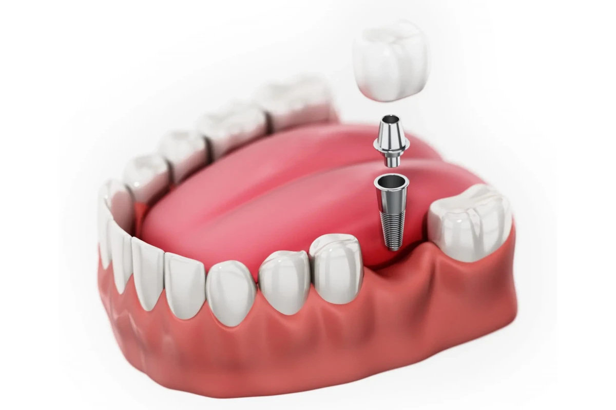 Single Dental Implants img