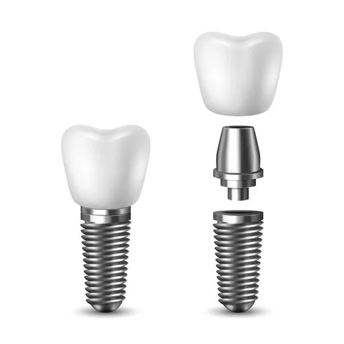 single dental implant